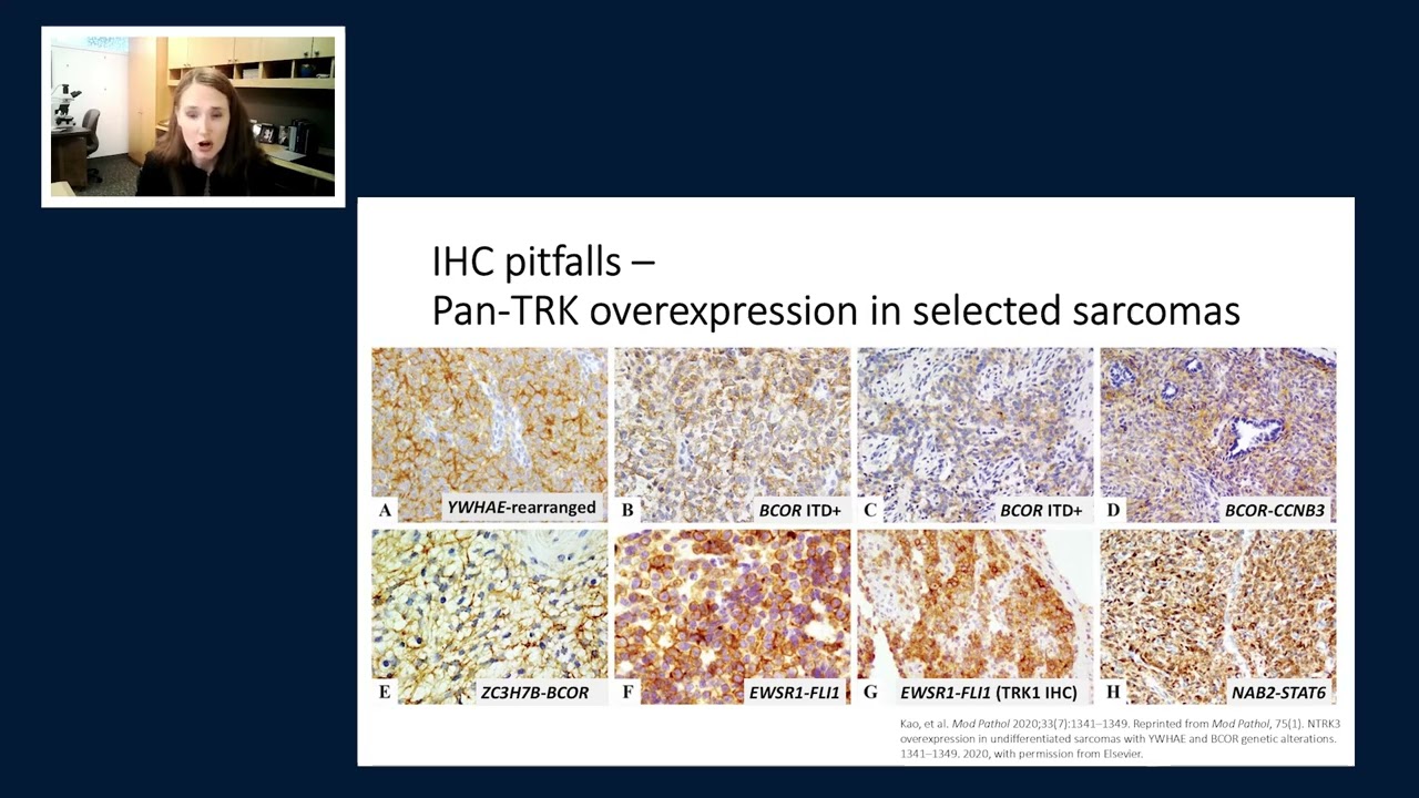 NTRK fusion-positive NSCLC: perspectives from pathology, oncology, and beyond