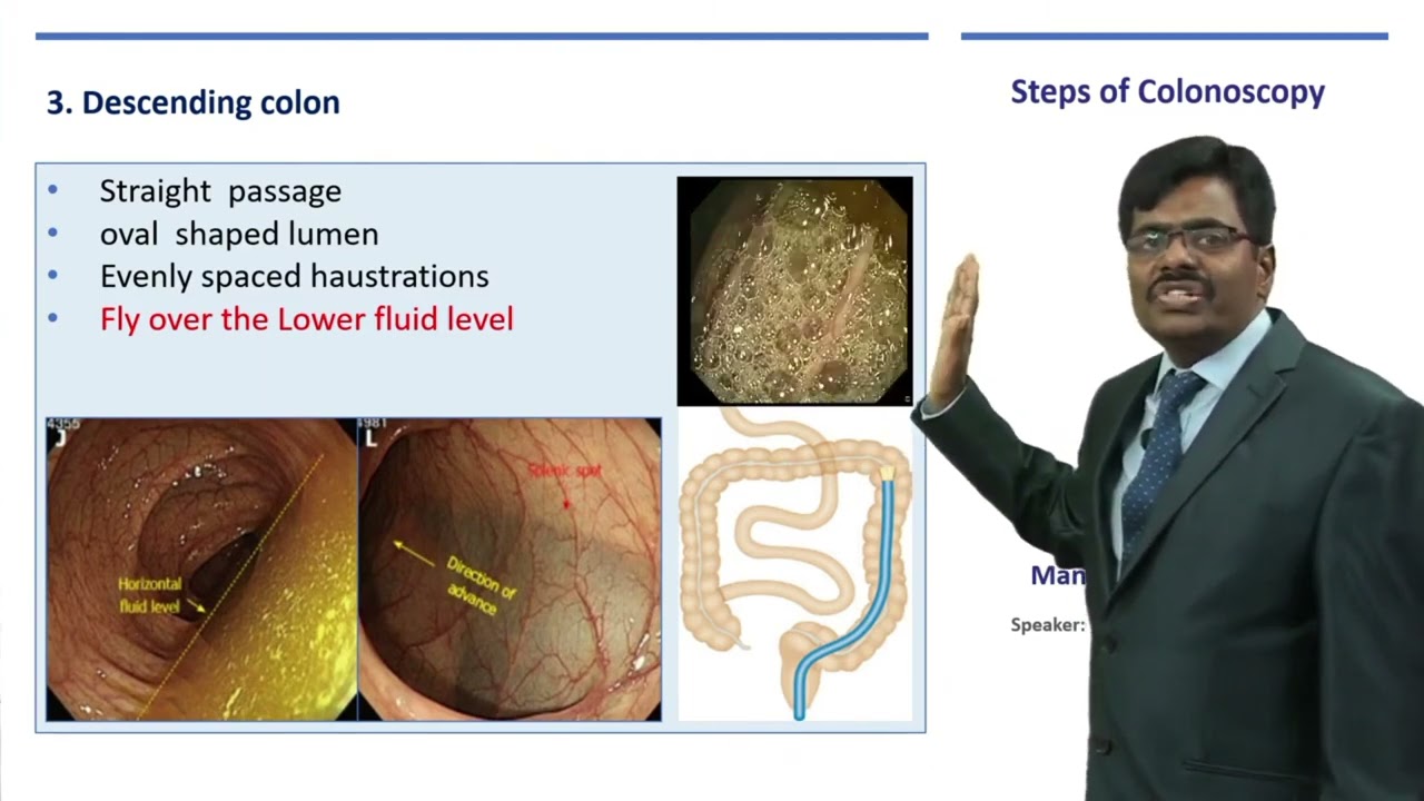 colonoscopy,  step by step 🚶&zwj;♀️. Basics and summary