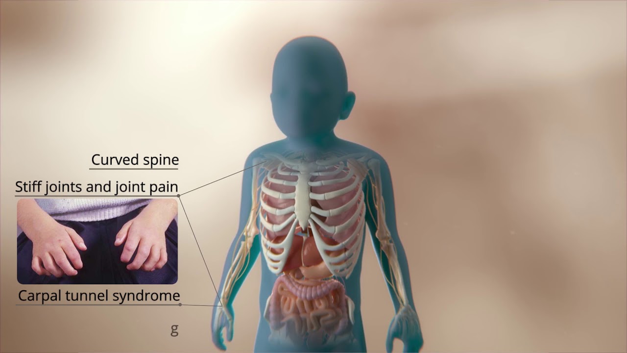 An Inside look at Mucopolysaccharidosis Type I (MPS I)