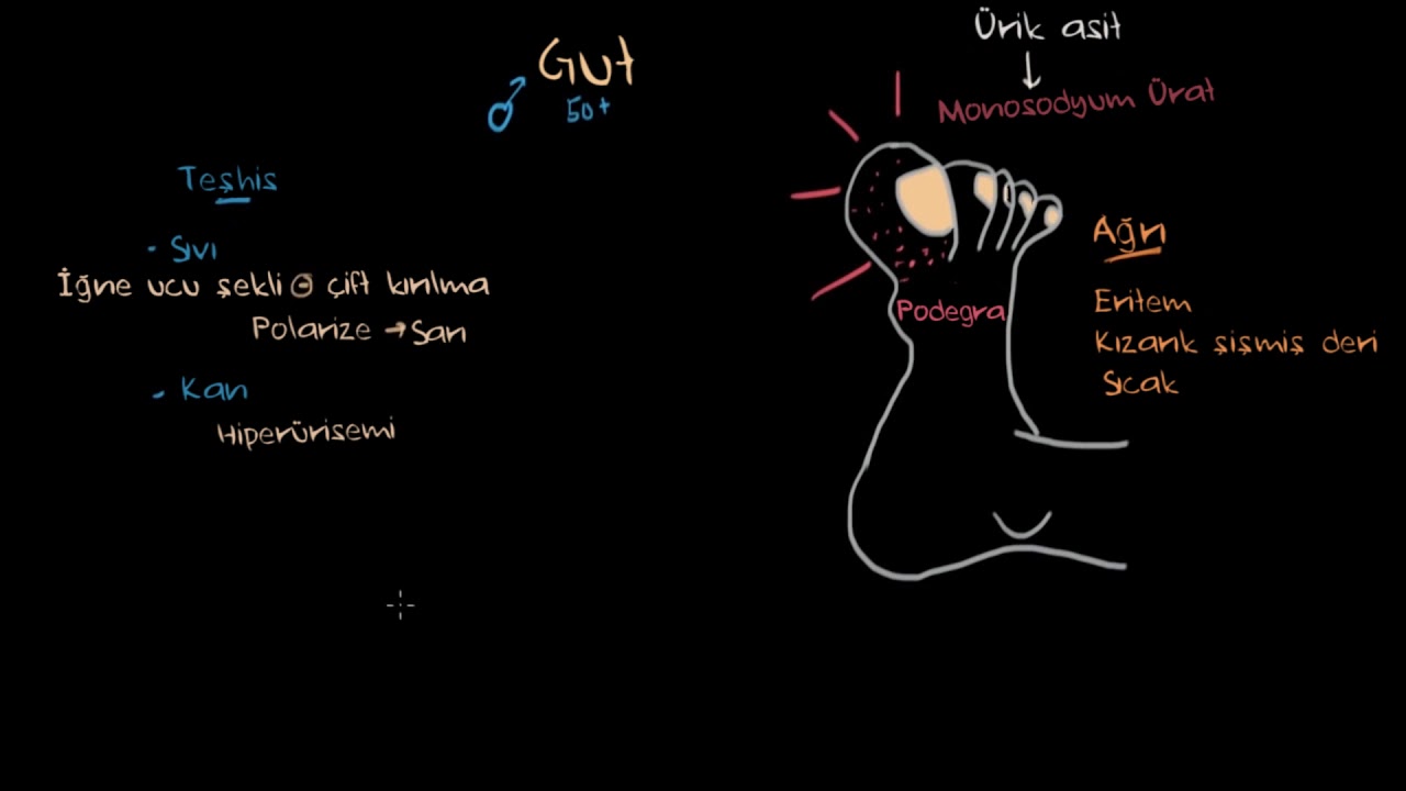 Gut  ve Yalancı Gut Hastalığı   (Fen Bilimleri) (Sağlık ve Tıp)