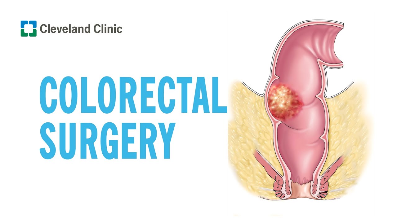 Colorectal Surgery | Cleveland Clinic