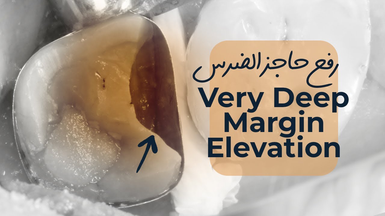 Very Deep Margin Elevation DME UL6 & 7