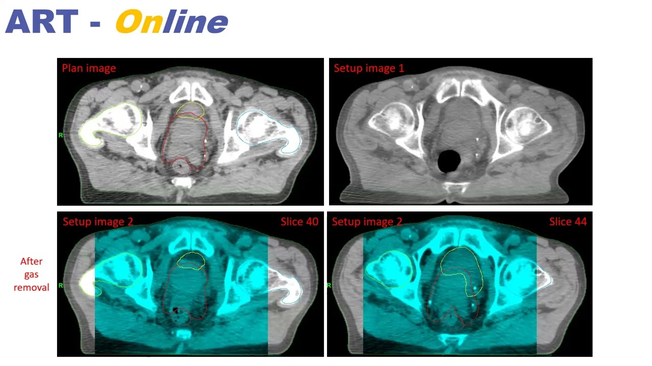 Nathan Corradini: Real-time tumor tracking and adaptive radiotherapy at Gruppo Ospedaliero Moncucco