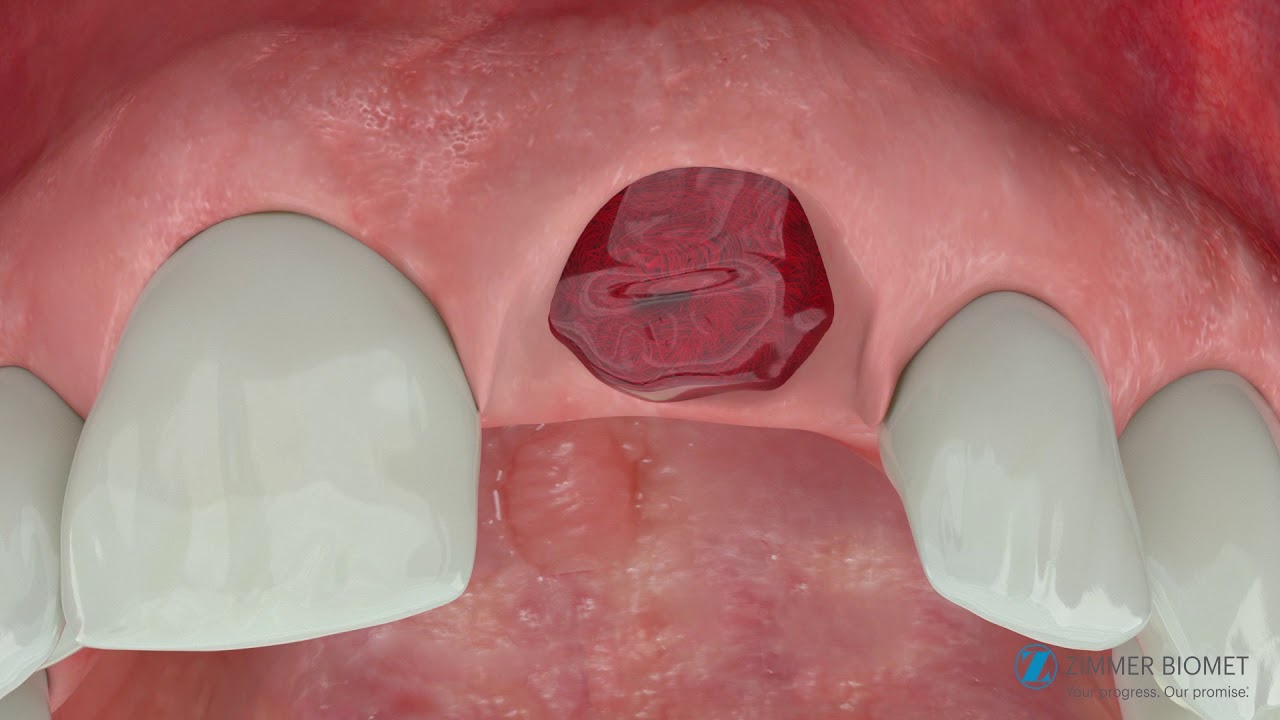 Simultaneous T3® Implants in the Aesthetic Zone