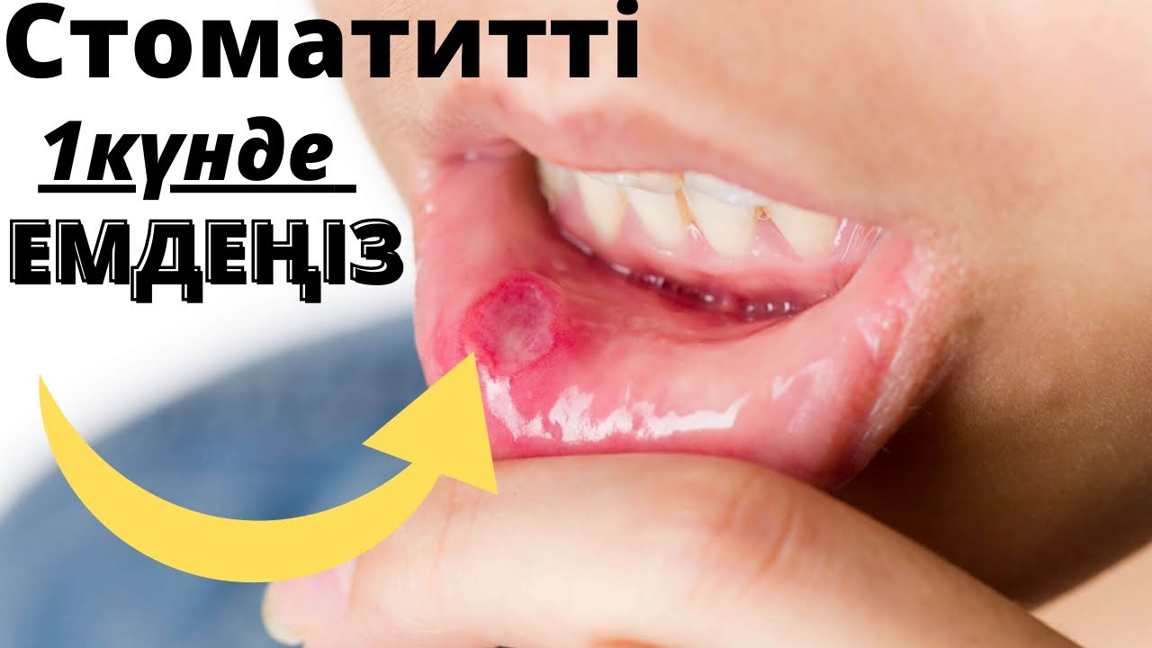 Стоматитті емдеу оңай😨Тіл ойылғанда не істеу керек? Ауыз ойылғанда не істеу керек?