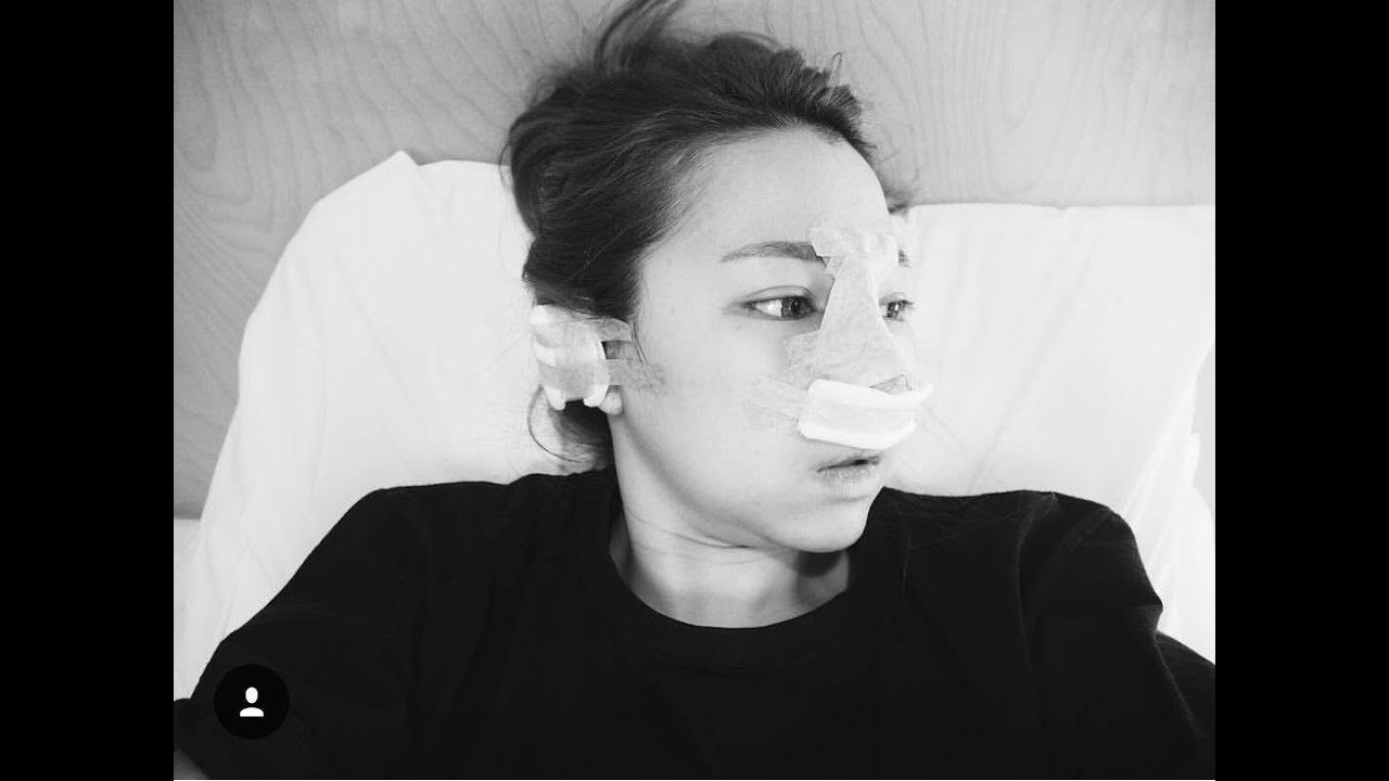 phẫu thuật thẩm mỹ Hàn Quốc - tư vấn nâng mũi