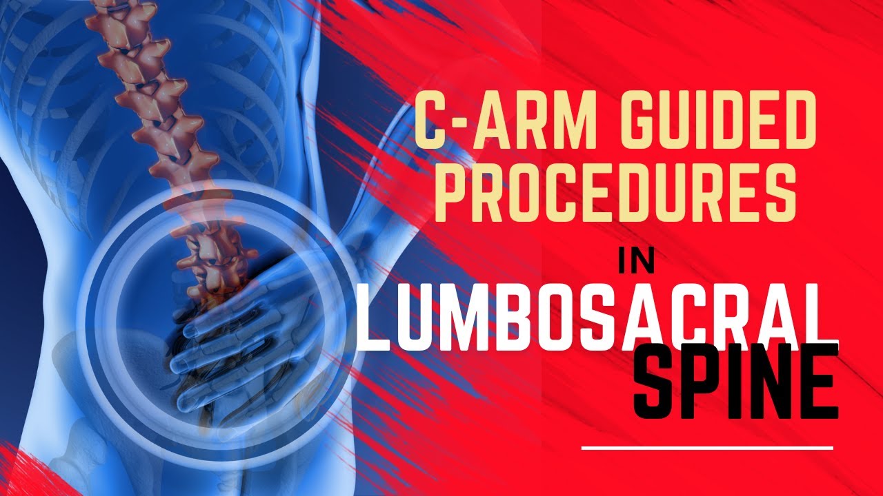 Mastering C-Arm Guided Interventional Pain Procedures at Lumbosacral Spine: Tips for Pain Physicians