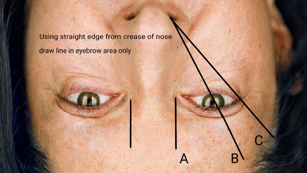 Brow Mapping with No Eyebrows
