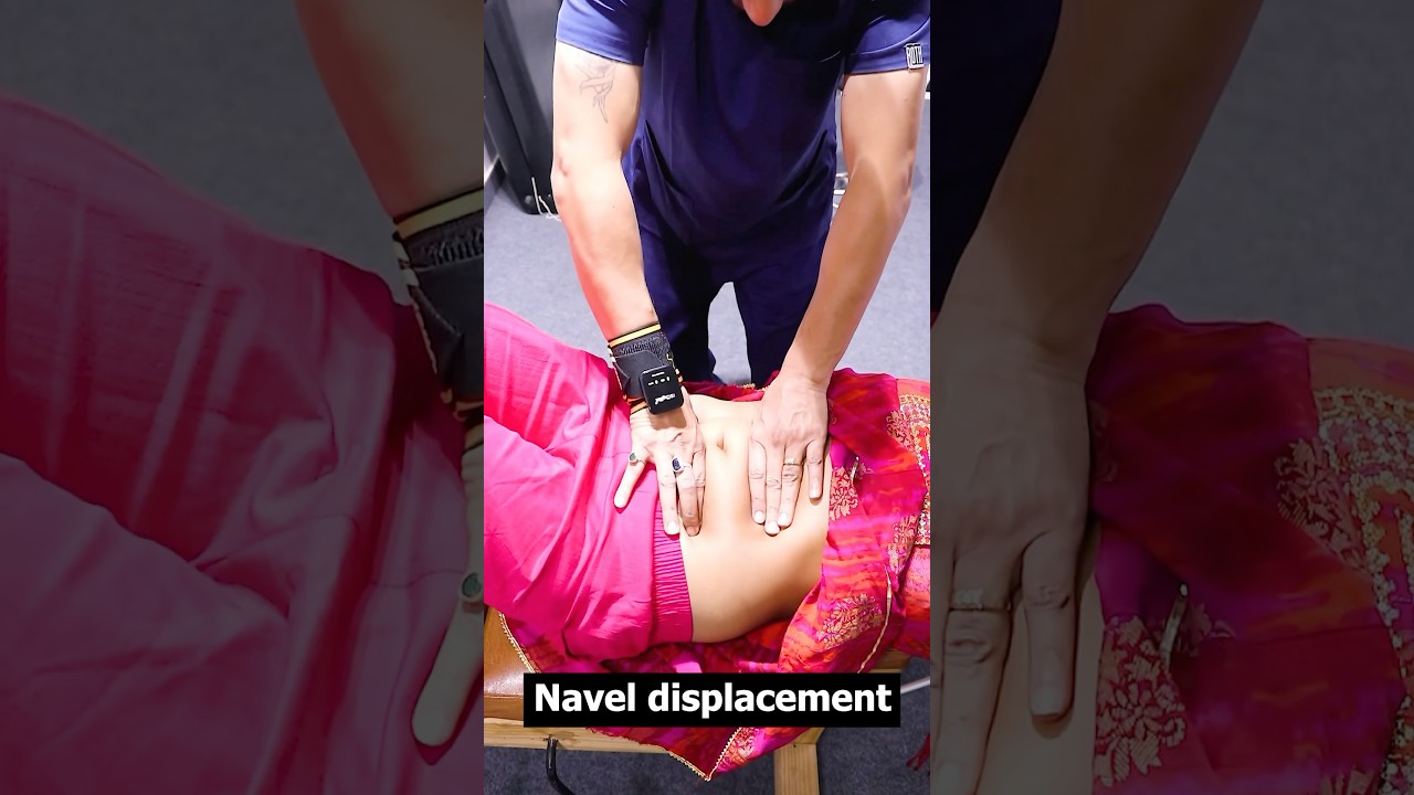 Navel displacement treatment by dr. Pankaj|#Bestosteopathinhyderabad|#trendingshorts|#navel|#Asmr|