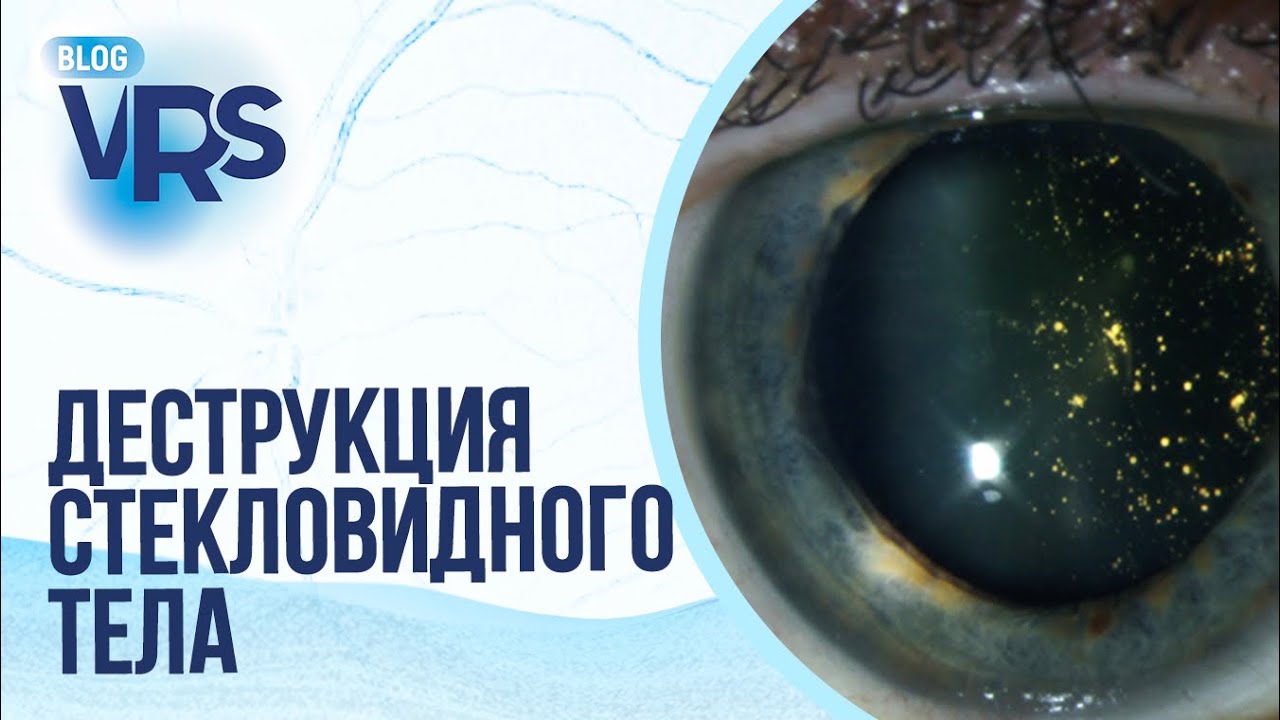 Деструкция стекловидного тела. Нужно ли оперировать? Мнение иностранных коллег.