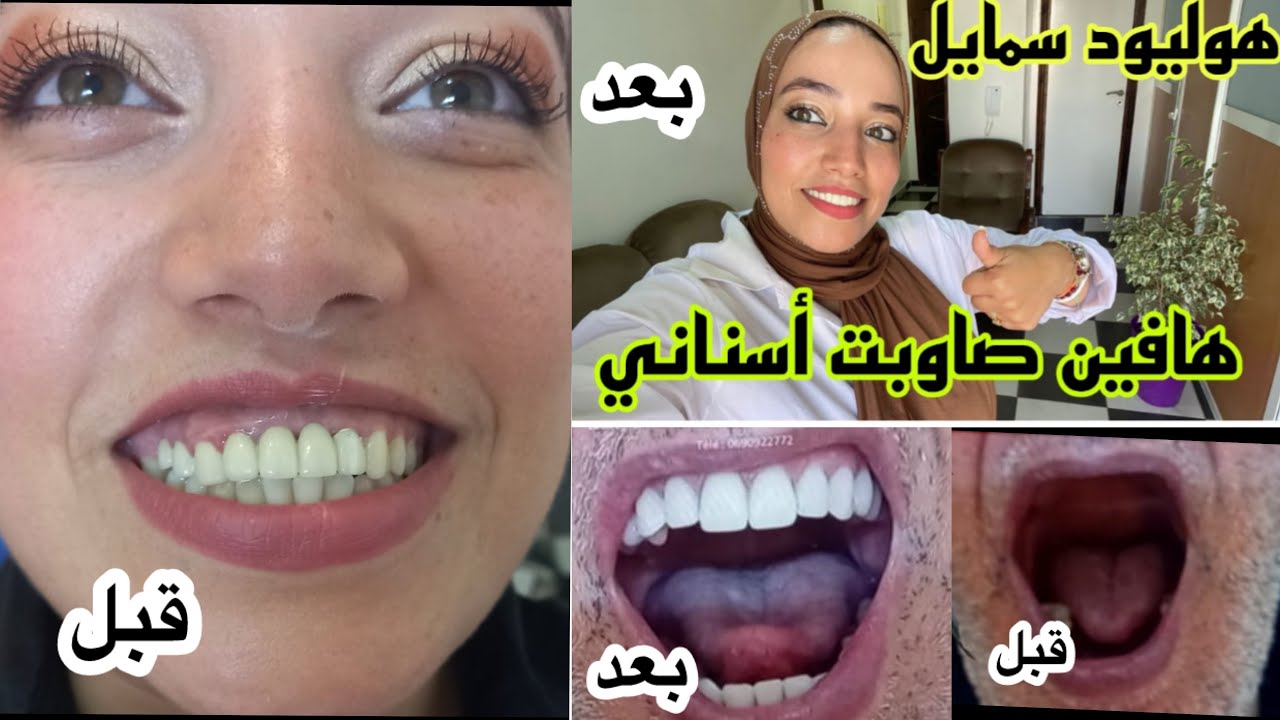 وأخييرااا📣هافين صاوبت سناني 📣 ثمن ولاد الشعب هوليوود سمايل الذي كلشي كيقلب عليه 😍