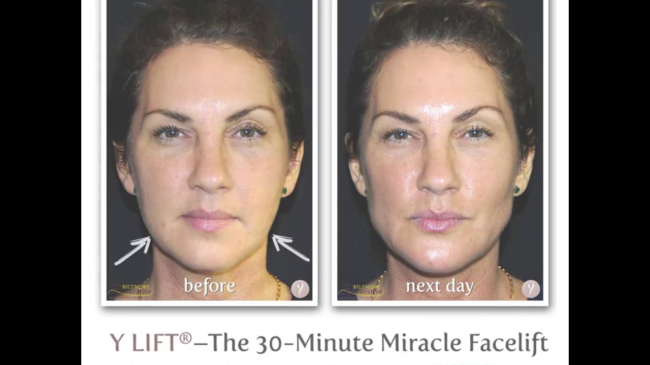 Patient Maria Luisa Discusses the Amazing Y-Lift Procedure