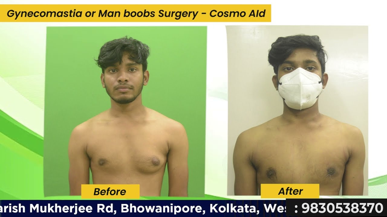 Man Boob Surgery Male Breast Interview in Kolkata I Gynecomastia Surgery in Kolkata 😃   Dr Nagwani