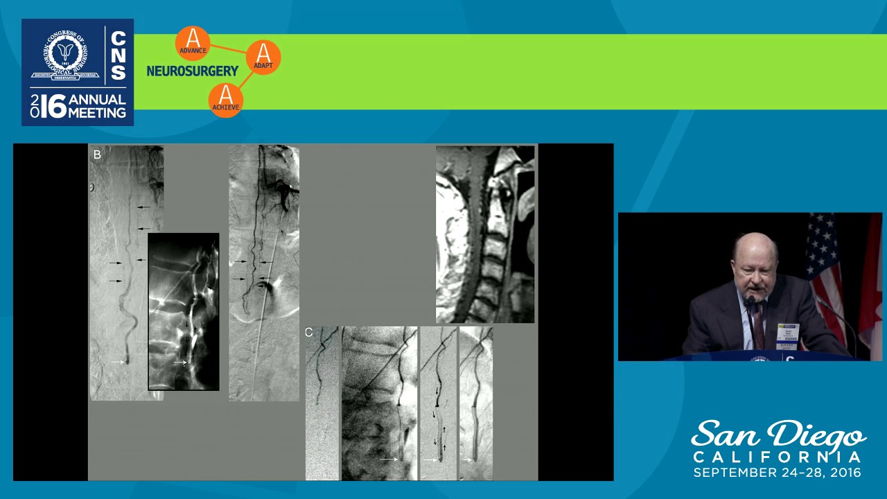 Spinal Dural Arteriovenous Fistulas: 40 Years of Progress - Unanswered Issues
