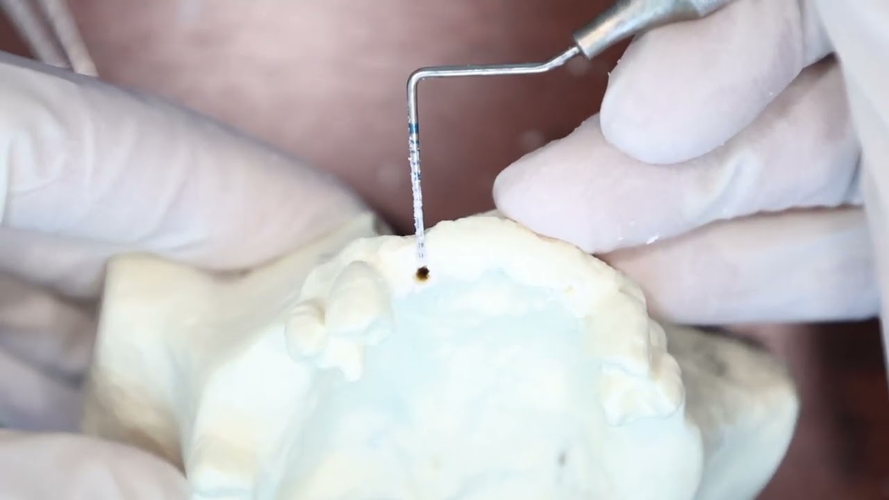 Monoimplant Placement Demo (Maxillary Anterior Region)