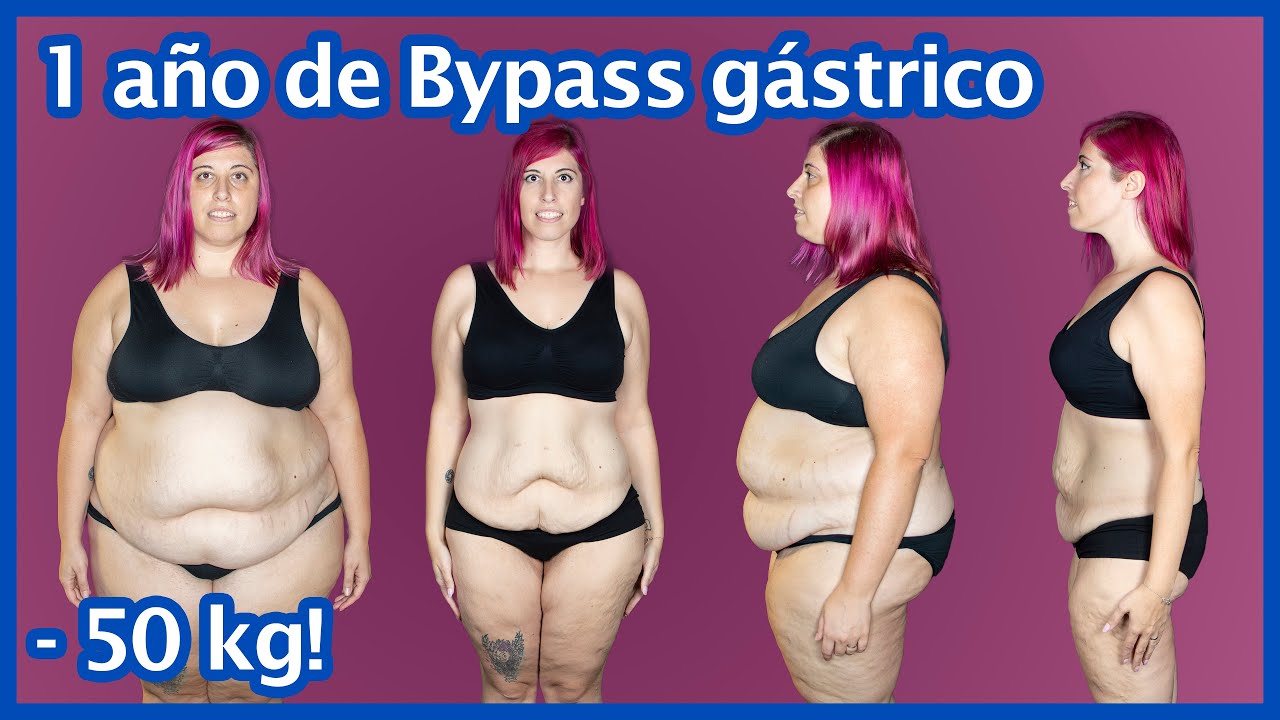 1 año de Bypass gástrico - Comparativa de fotos
