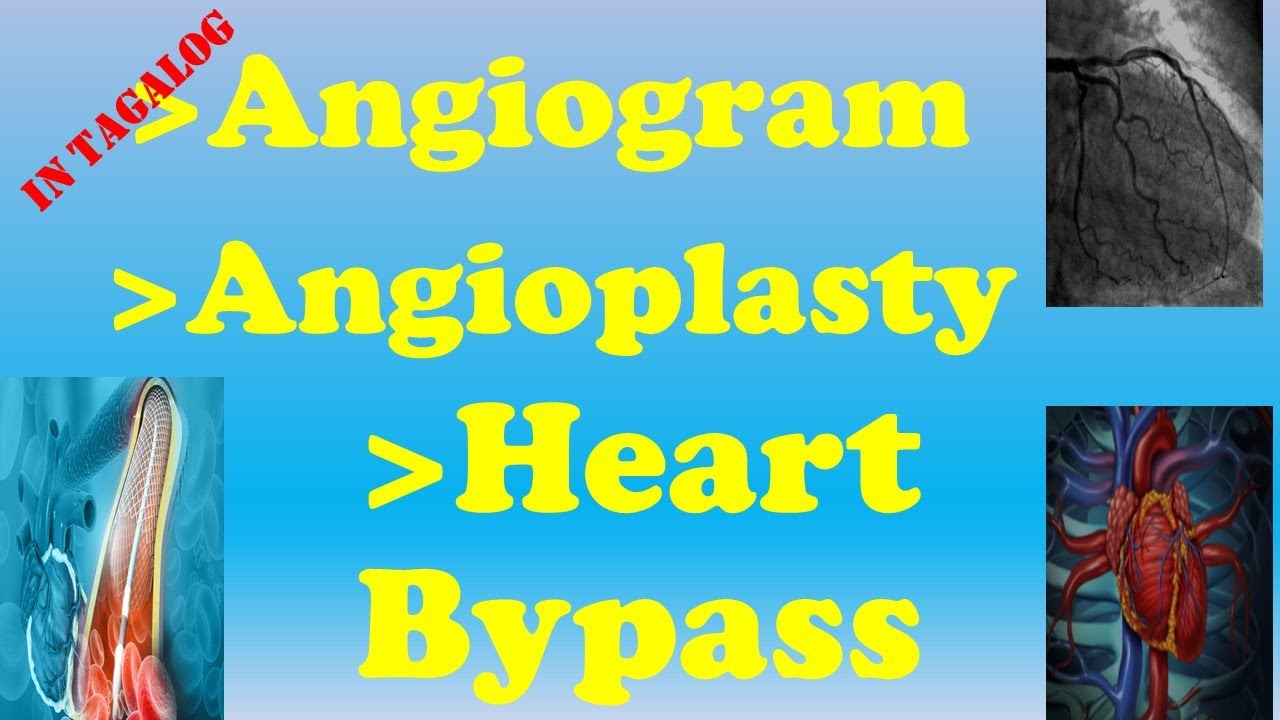 Ano ang Angiogram, Angioplasty, at Heart Bypass?