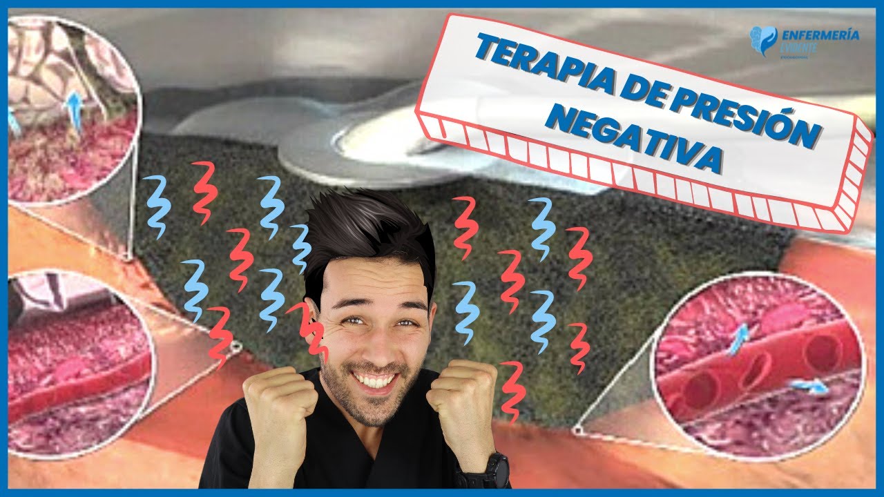 💥¿Qué es la TERAPIA de PRESIÓN NEGATIVA? y🚀 ¿Cómo FUNCIONA?...