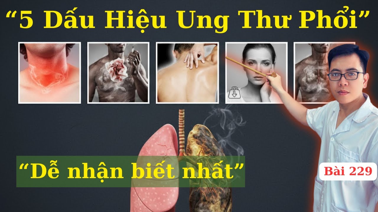 5 Dấu Hiệu Cảnh Báo Ung Thư Phổi Dễ Nhận Biết Mà Bạn Không Thể Bỏ Qua