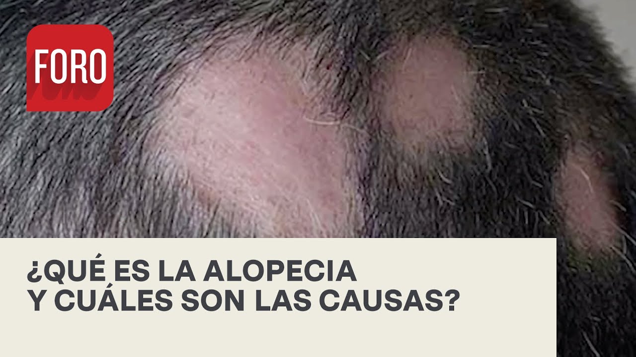 Las causas de la alopecia - Las Noticias
