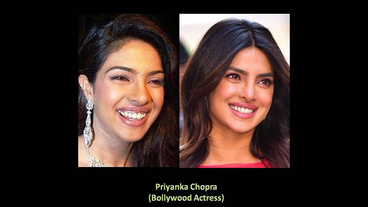 Celebrities who got their Smile Corrected with Braces or Dental Treatment