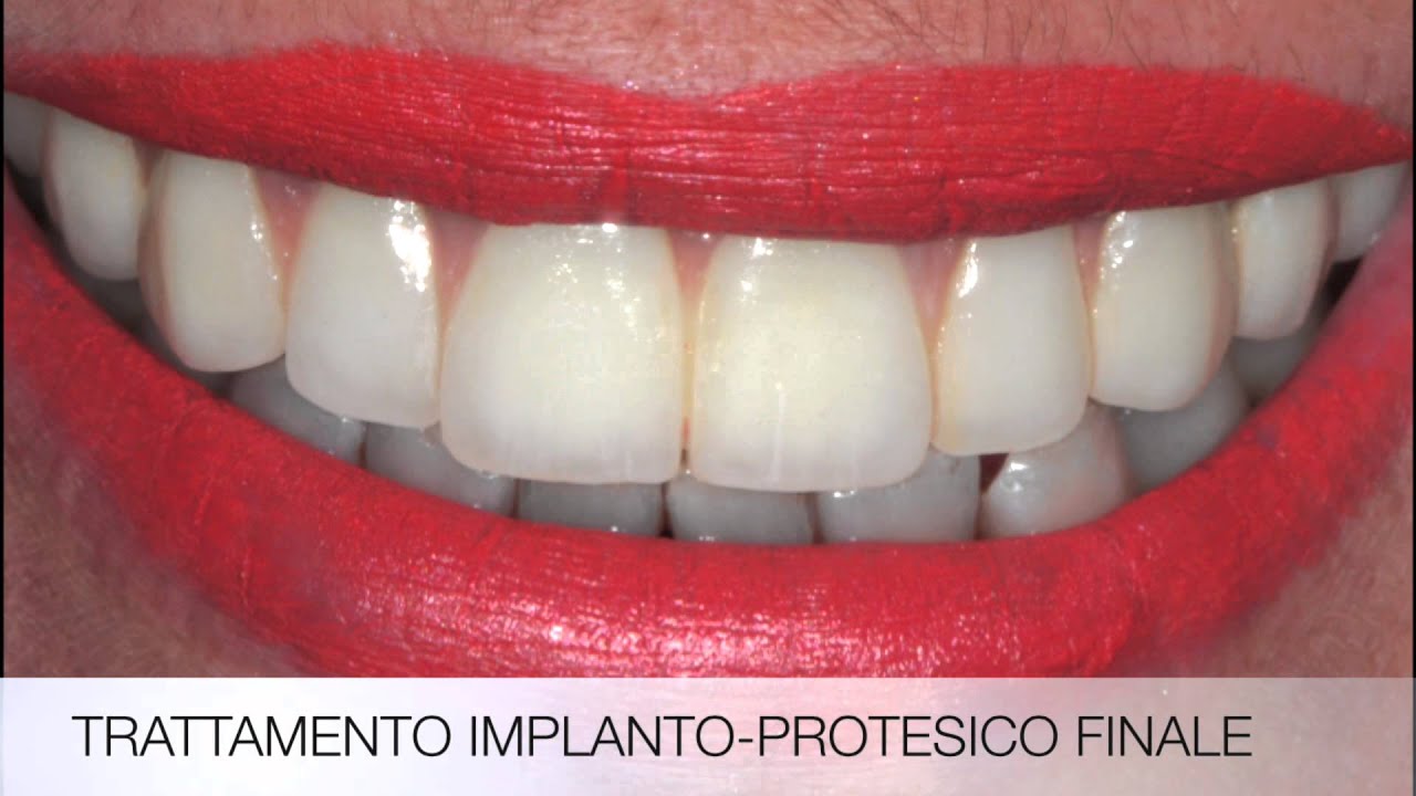 All-on-4&reg; | Toronto su Impianti | Studio odontoiatrico Mingione