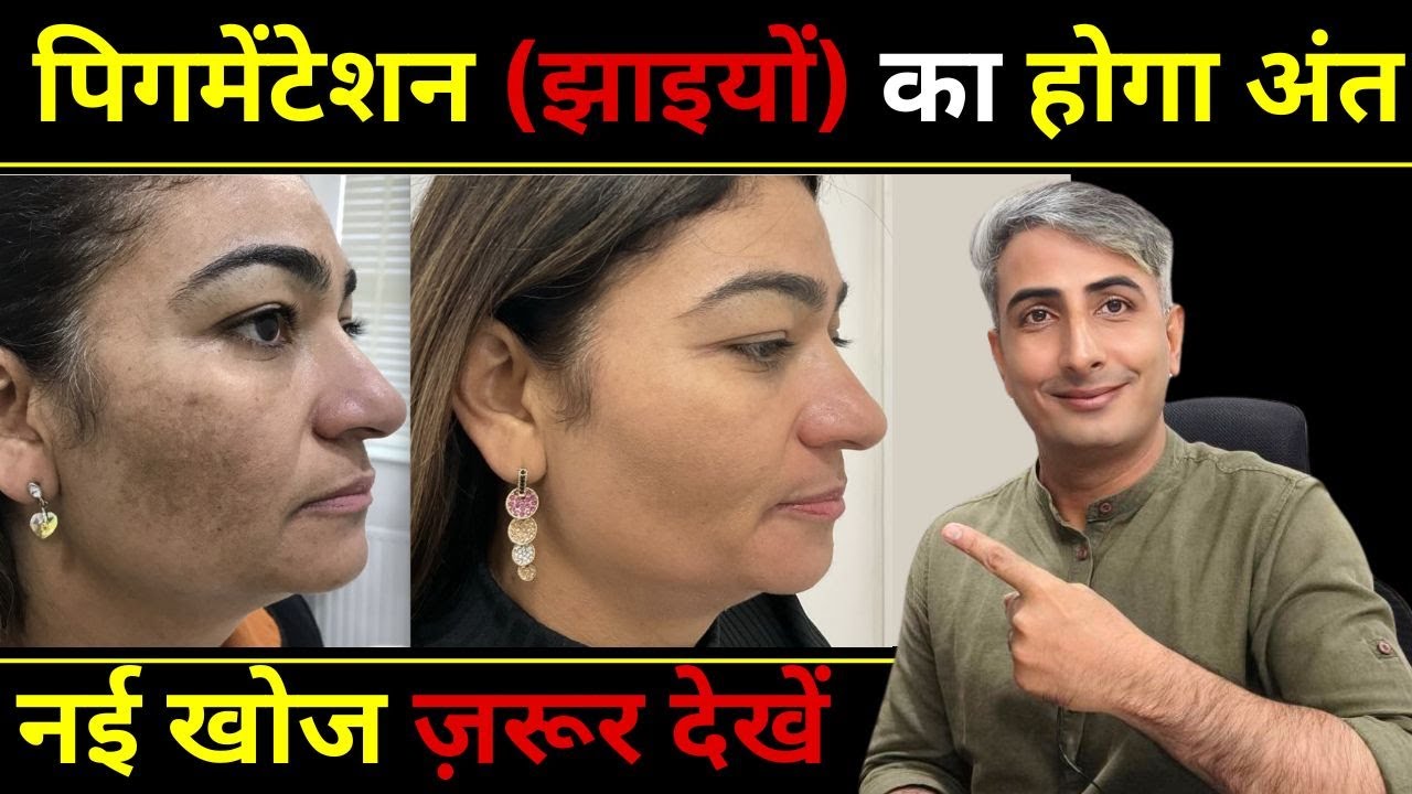 गोरी और बेदाग त्वचा पाने का राज I Secret to Fair and Flawless Skin I DR. MANOJ DAS