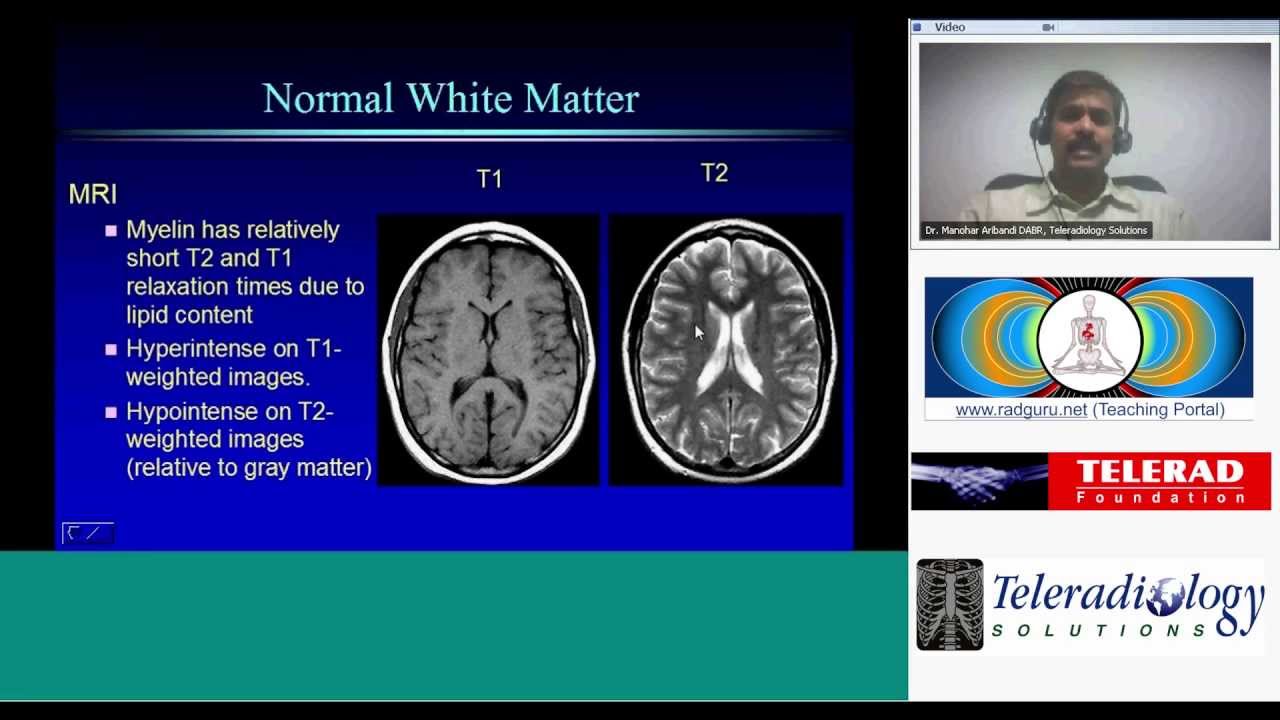 Congenital White Matter Diseases by Dr Manohar Aribandi