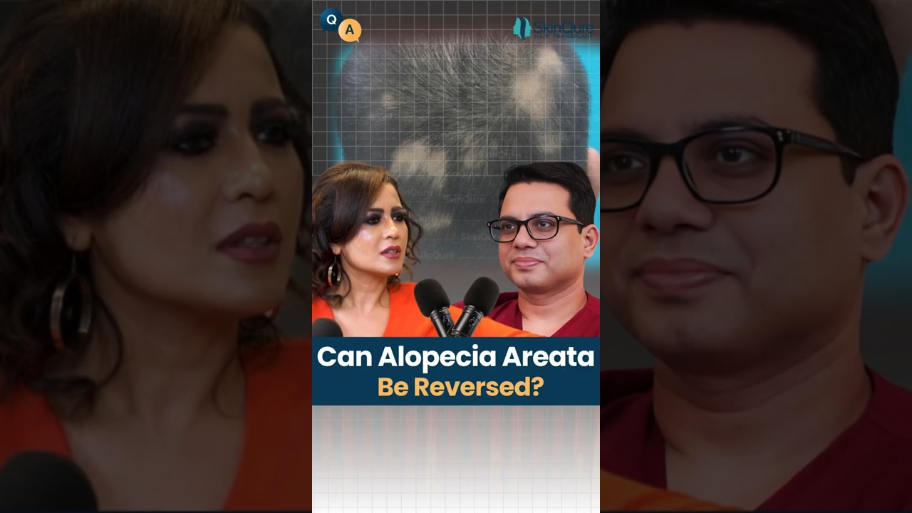 Alopecia Areata Treatment | Dr Jangid Explains | #alopecia #shorts