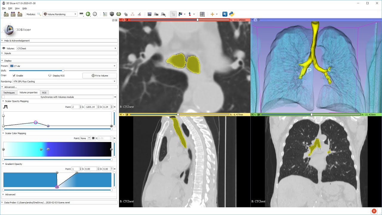 Airway segmentation from CT in 1 minute using 3D Slicer