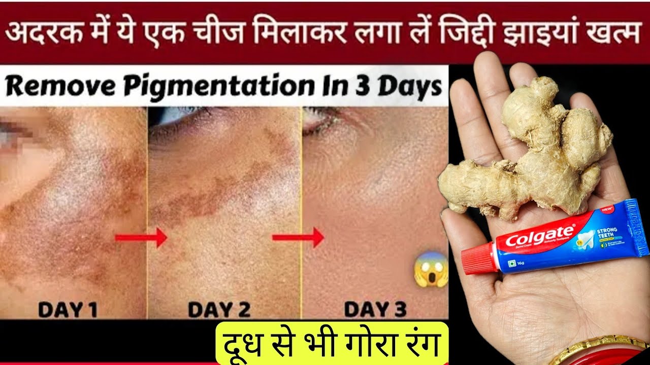 अदरक से काली झाइयां हटाने का जादूई तरीका II Reduce Melasma, Pigmentation, Discoloration, Blackspots
