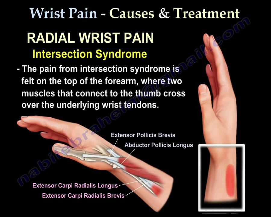 Wrist Pain,causes and treatment,Part 2 - Everything You Need To Know - Dr. Nabil Ebraheim