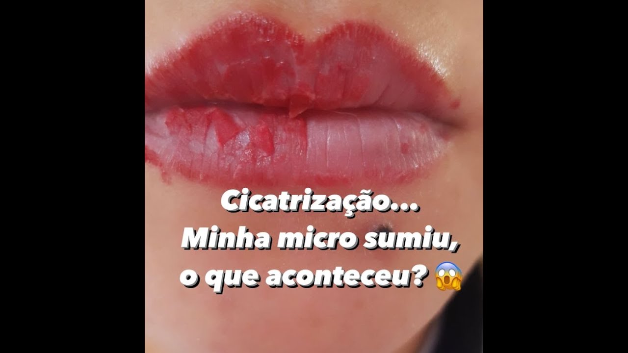 Cicatrização... Minha micro sumiu, oq aconteceu?