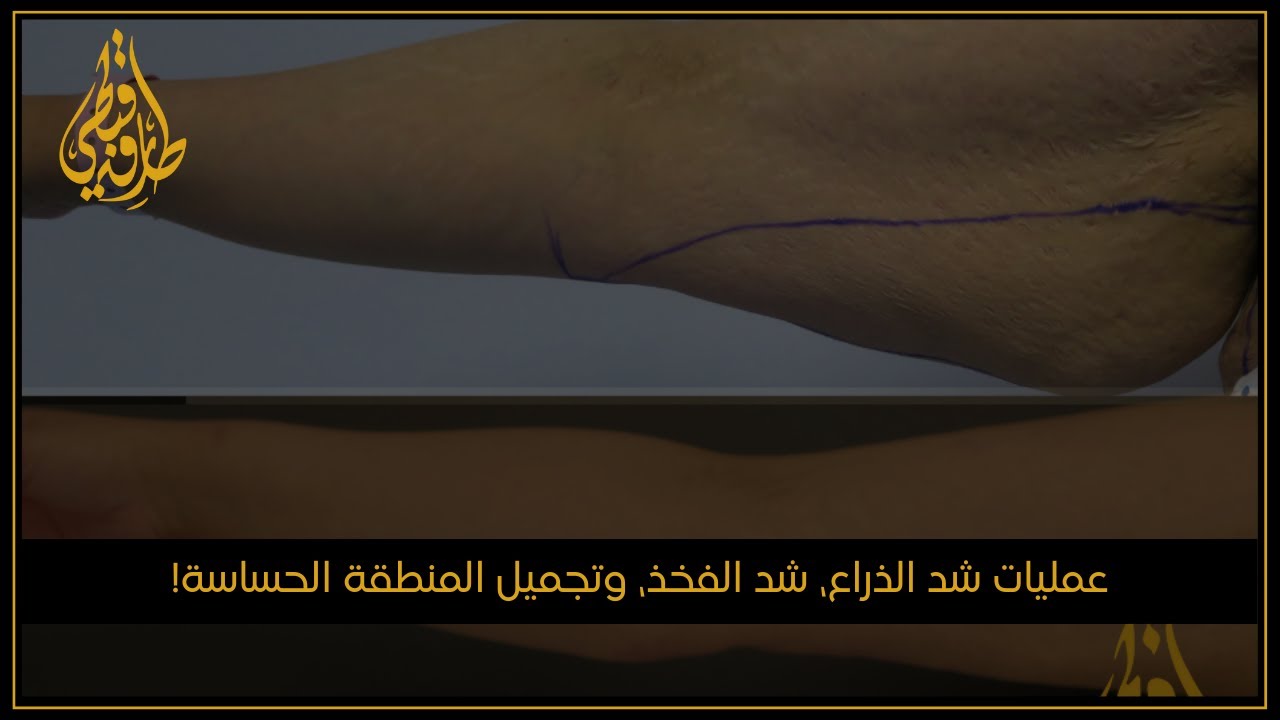 الدكتور طارق قبطي للتجميل| عمليات شد الذراع، شد الفخذ، وتجميل المنطقة الحساسة