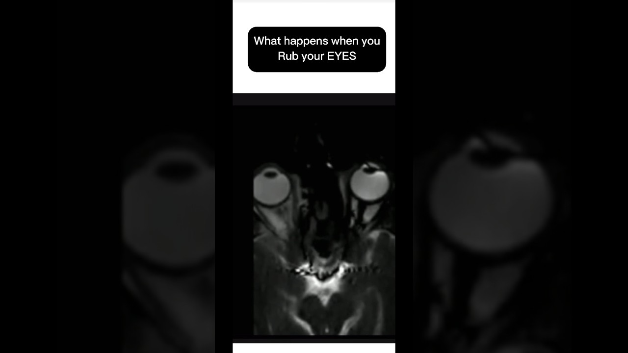 WHAT HAPPENS WHEN YOU RUB YOUR EYES?
