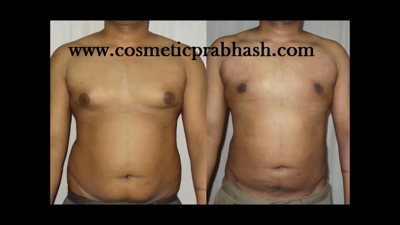 Best Gynecomastia Surgery Before After 3 & 6 months, 1 year | Gynecomastia Cost, Delhi, India 