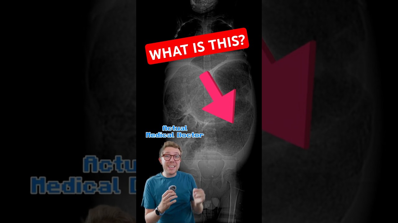 Doctor SHOCKED by Toxic Megacolon ⚠️ #medicalemergency #health