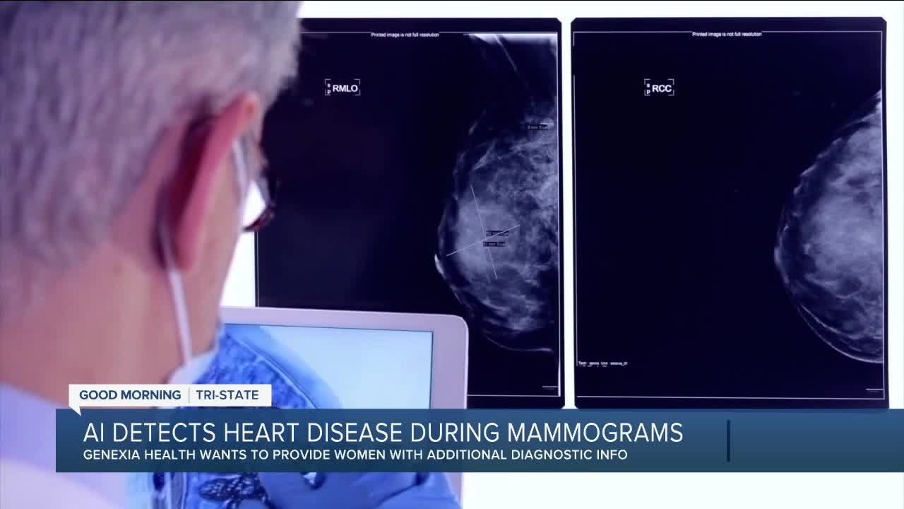 AI helps healthcare detect heart disease during mammograms