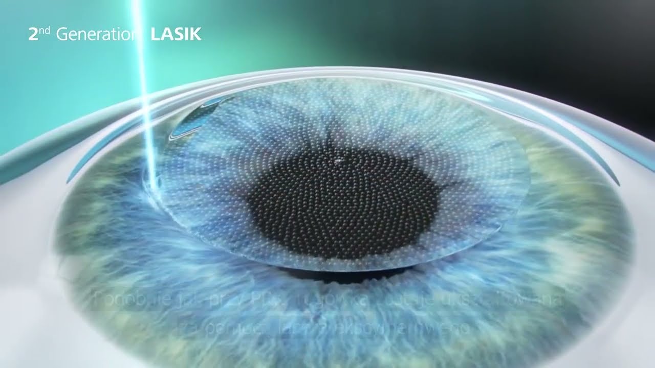 Laserowa korekcja wzroku - metodą SMILE w Eye Laser Center