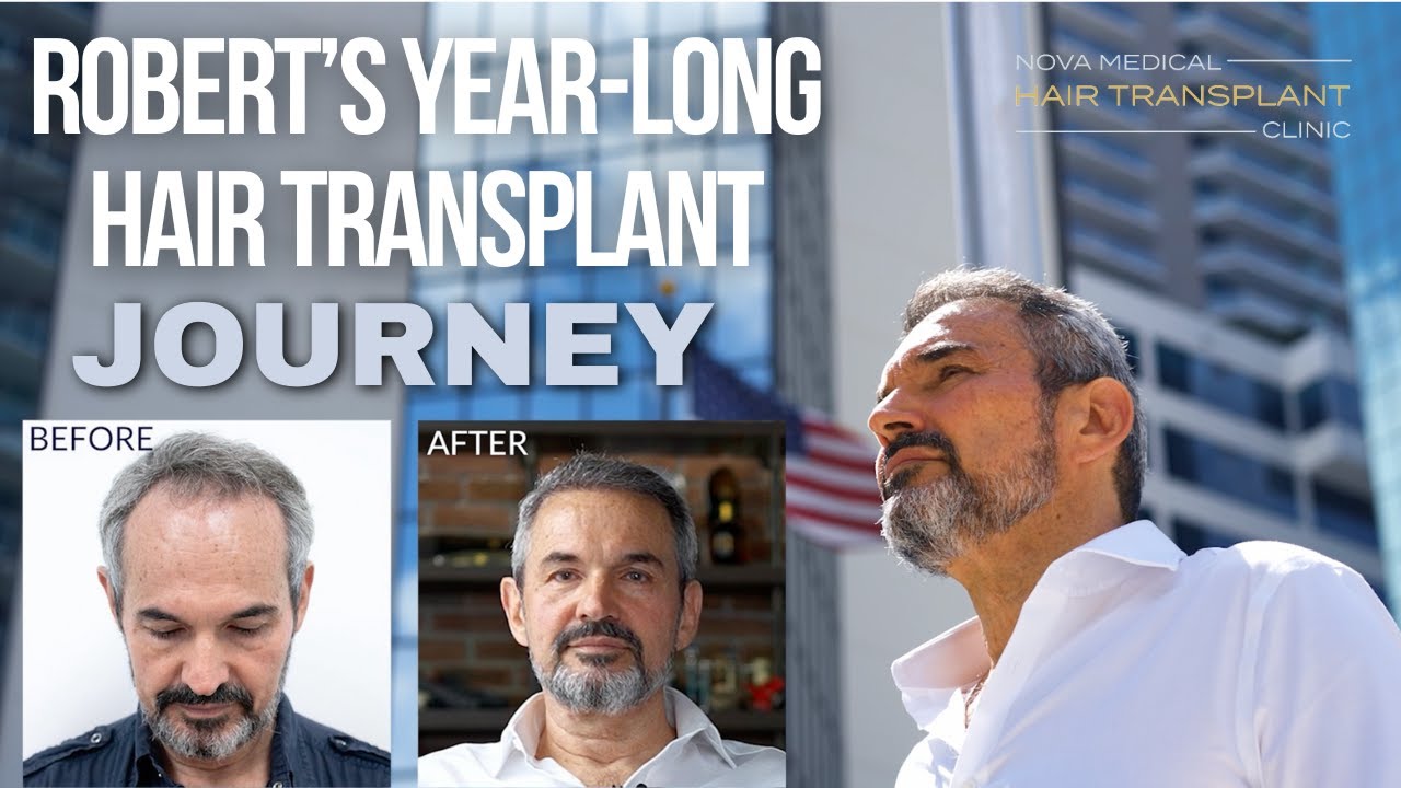 Robert's Year-long Hair Restoration Journey | Nova Medical Hair Transplant Clinic