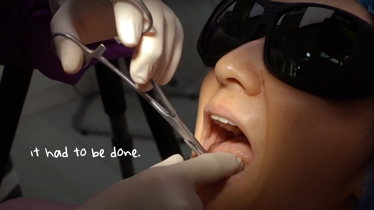 This is what being 'tongue-tied' looks like (I had a tongue procedure) | Rica Peralejo - Bonifacio