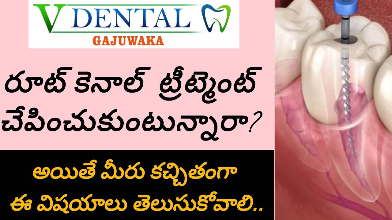 Root canal treatment ఎందుకు చేయించాలి? ఎప్పుడు చేయించాలి? ఎలాంటి జాగ్రత్తలు తీసుకోవాలి? #Rootcanal
