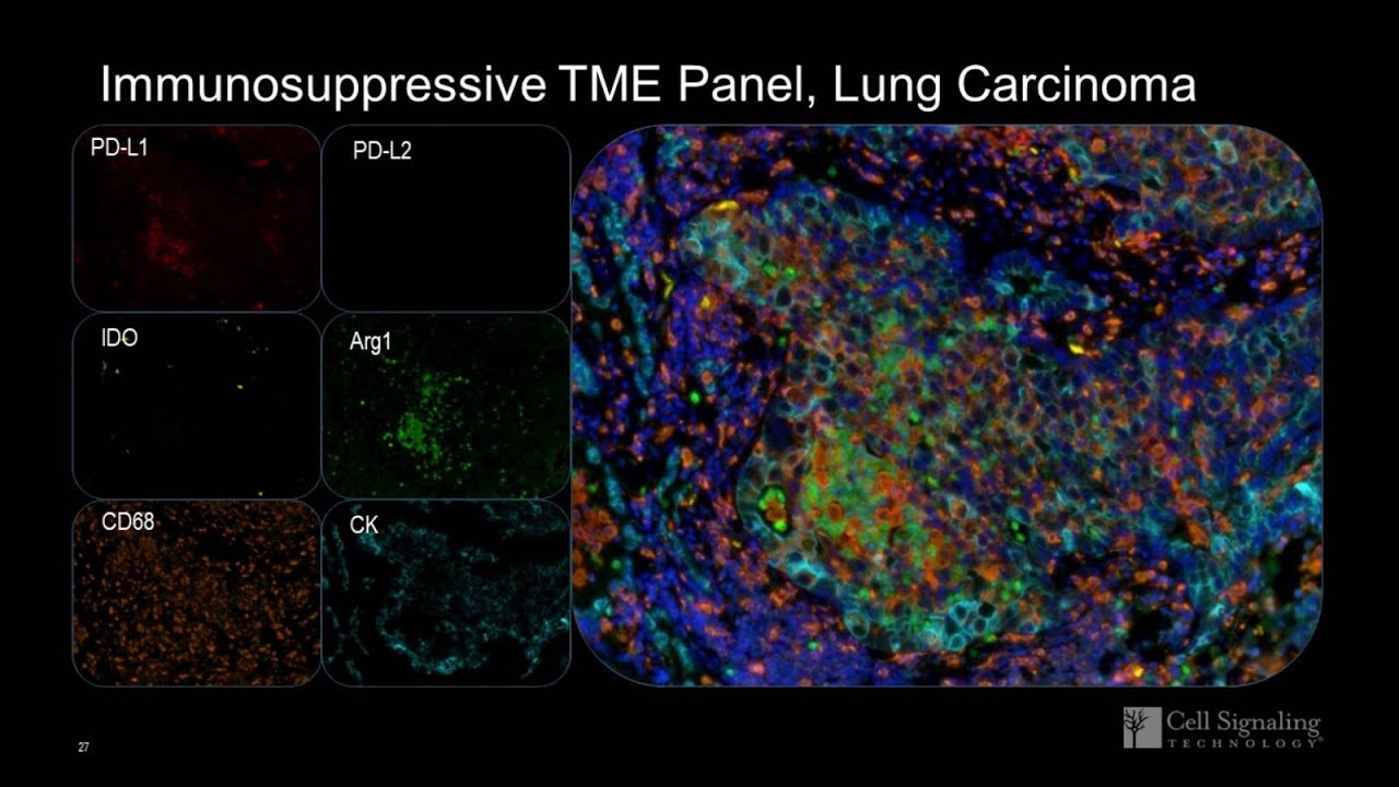 Myeloid Immunosuppression in the Tumor Microenvironment Characterized by Single/Multiplex IHC