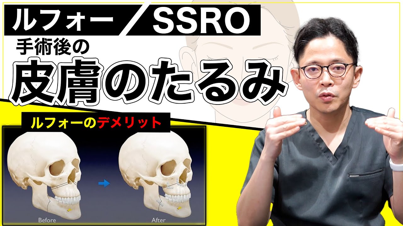 【ルフォー／SSRO】手術後の皮膚や組織のたるみはどうなる？？【ルフォー／SSROのデメリット】