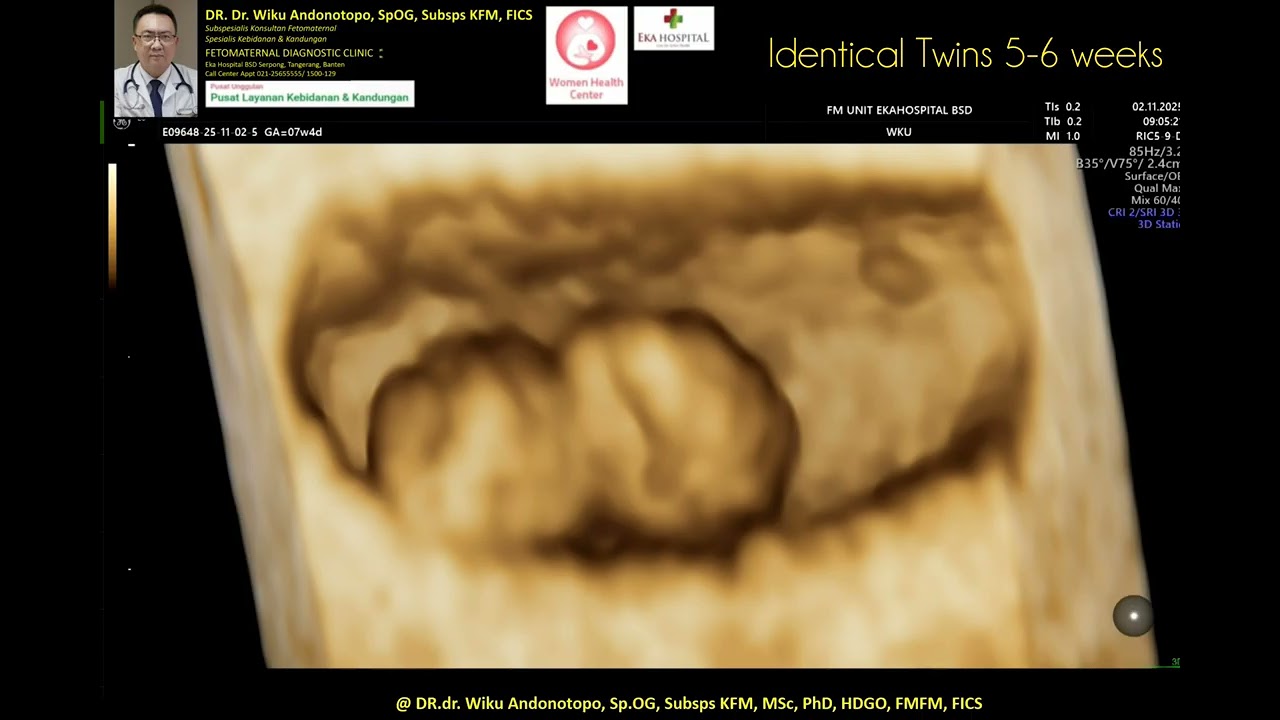 Identical twins 5-6 weeks