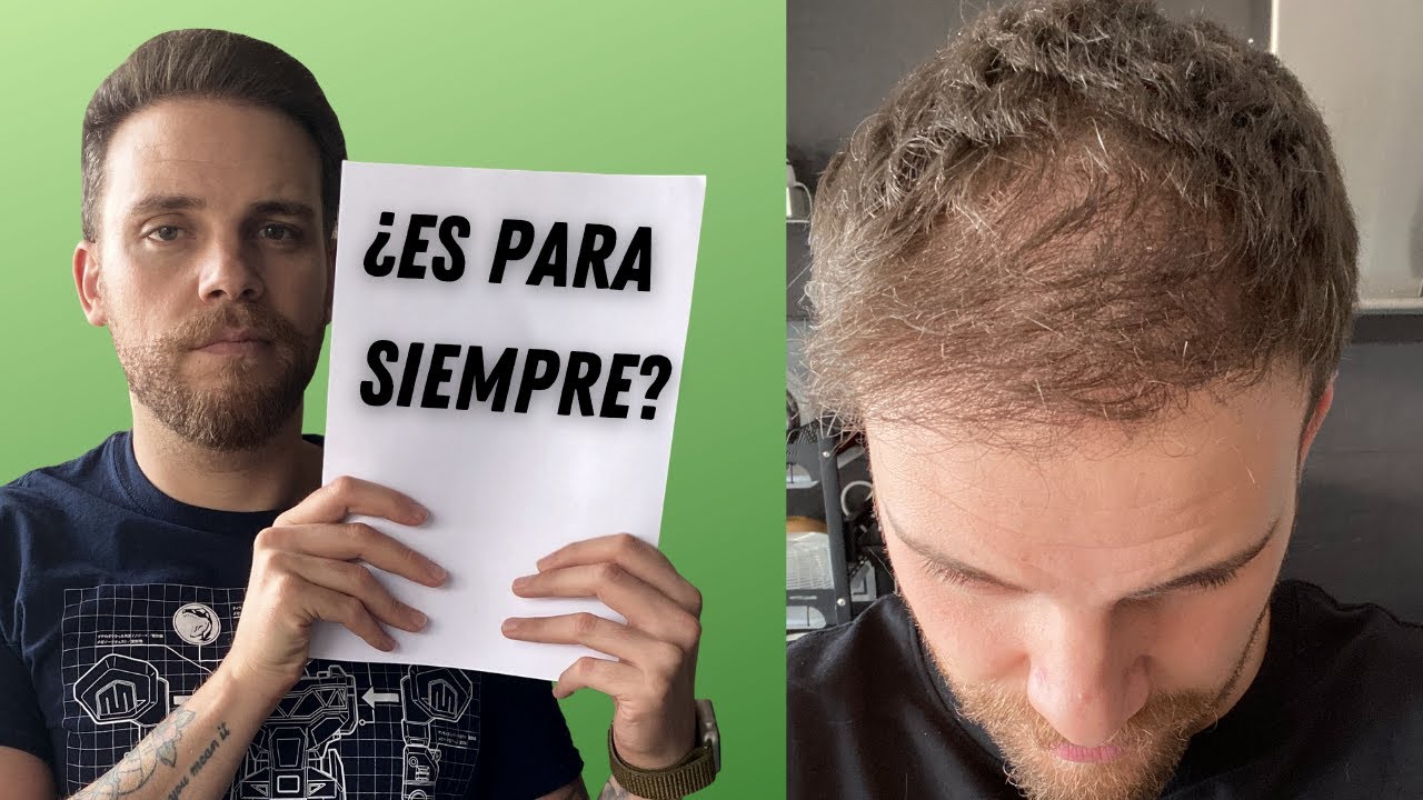 ¿SE CAE EL PELO TRASPLANTADO? ¿CUÁNTO PUEDE DURAR?