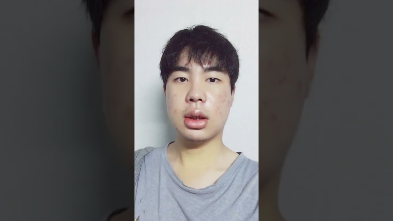 Two jaw surgery for men : Korea plastic surgery #shorts
