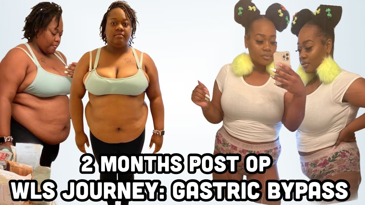 Gastric bypass | weightloss surgery | 2 Month Post Op