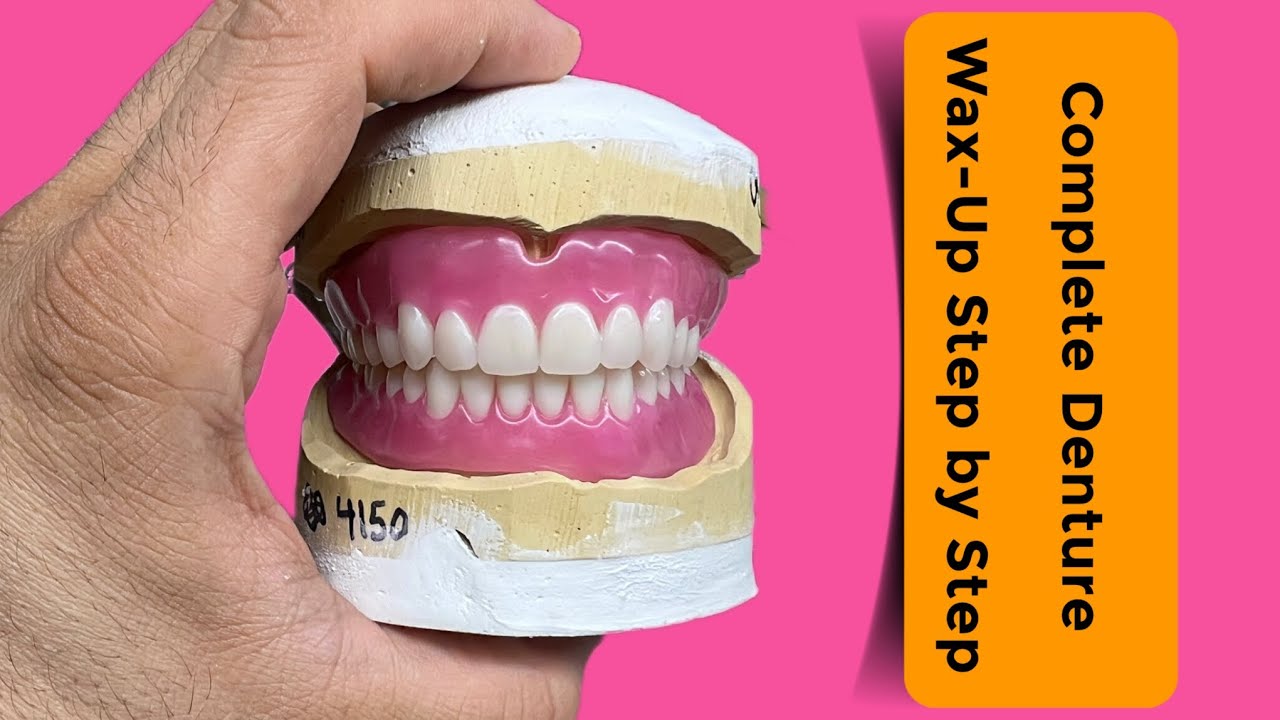 Full Denture Wax-Up Done ✔️ Try-In Ready