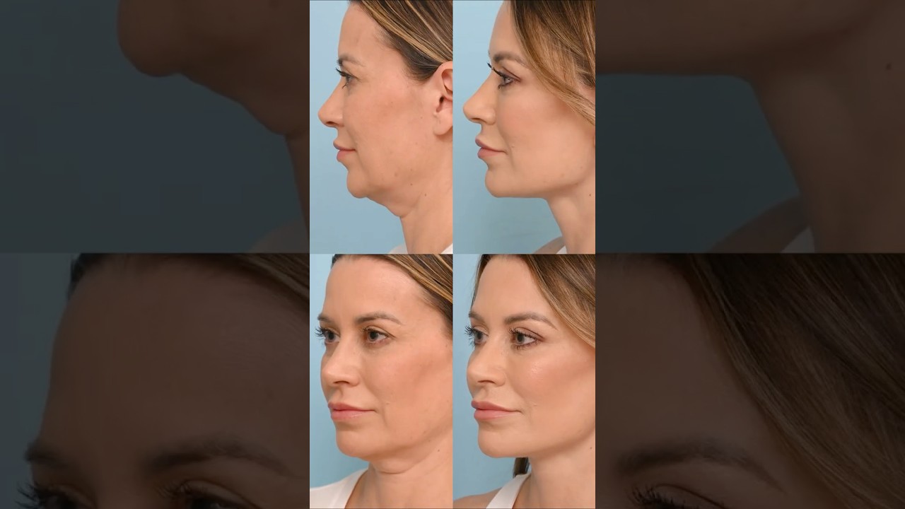 Why 50 Was the Right Time for My Deep Plane Facelift and Neck Lift